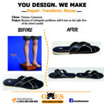 pied plus long que l'autre orthopedic problem apres chirurgie